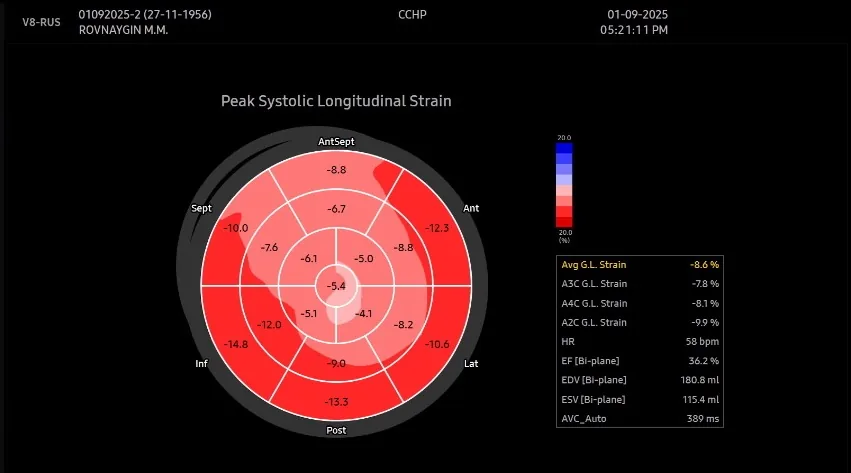 Strain+LV при инфаркте миокарда передней стенки, МЖП и верхушки