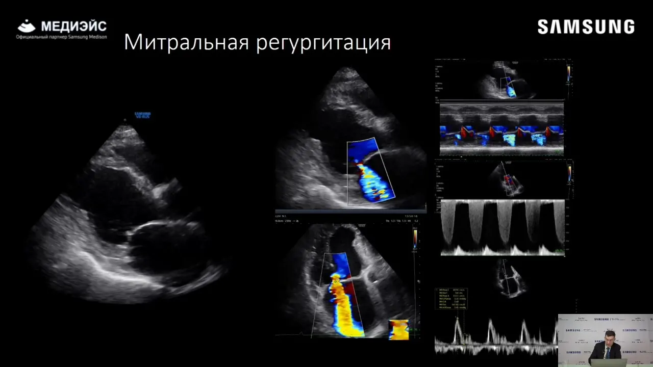 Превью: Эхокардиографическая оценка митральной регургитации. Клинические примеры.