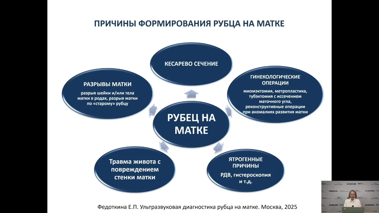 Превью: Ультразвуковая диагностика рубца на матке