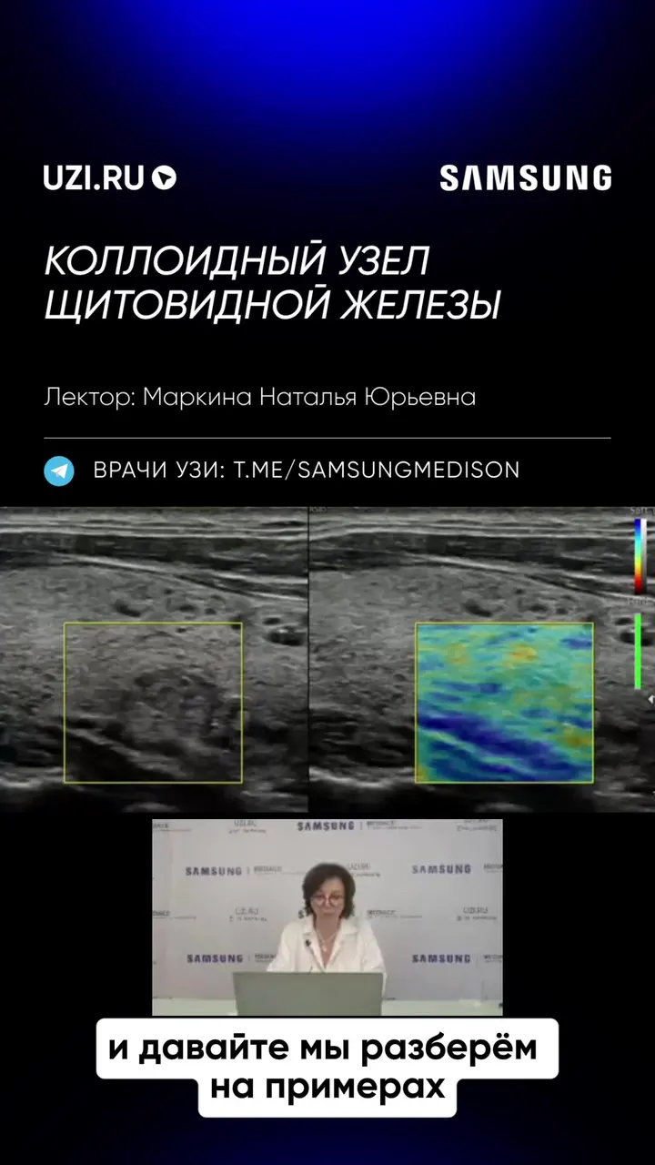 Щитовидная железа: Коллоидный узел щитовидной железы — Маркина Наталья Юрьевна