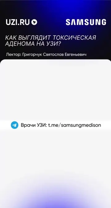 Щитовидная железа: Как выглядит токсическая аденома на УЗИ? — Григорчук Святослав Евгеньевич