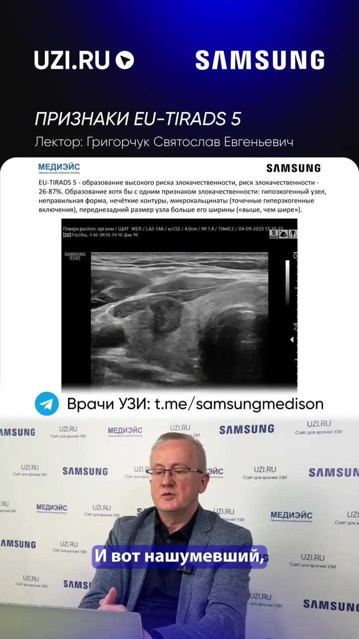 Щитовидная железа: Признаки EU-TIRADS 5 — Григорчук Святослав Евгеньевич