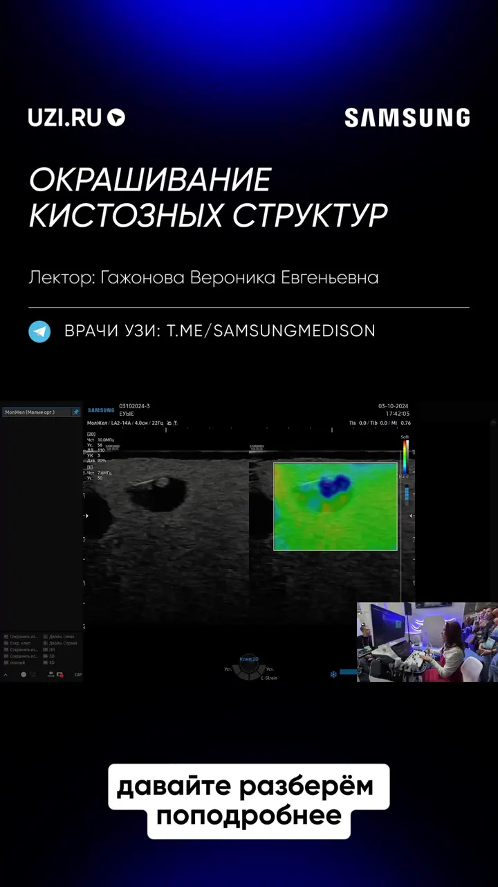 Молочная железа: Окрашивание кистозных структур — Гажонова Вероника Евгеньевна