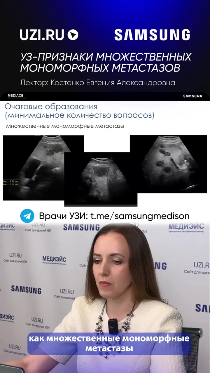 Печень: УЗ-признаки множественных мономорфных метастазов — Костенко Евгения Александровна